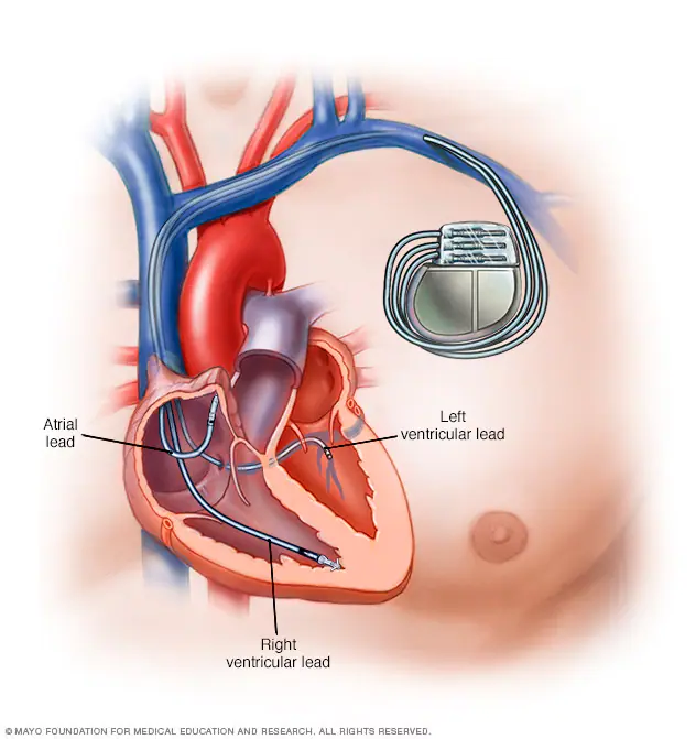 Pacemaker implant(heart battery)